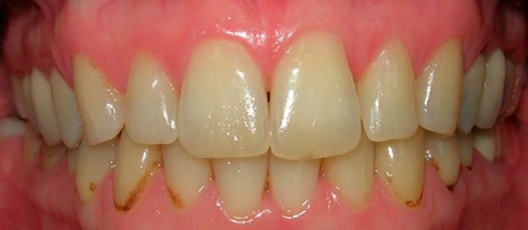 Причины образования зубного налета