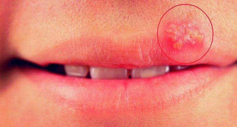 Причины герпеса на губах