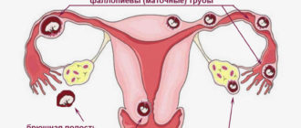 локализация внематочной беременности