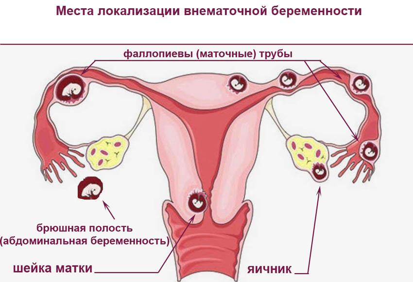 локализация внематочной беременности